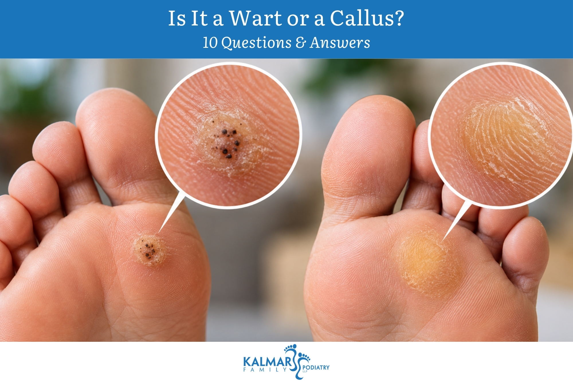 Is It a Wart or a Callus 10 Questions & Answers
