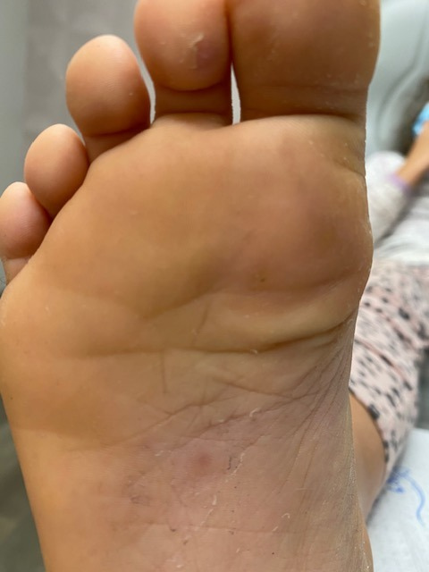 Plantar wart after Swift Microwave Therapy showing plantar wart has resolved