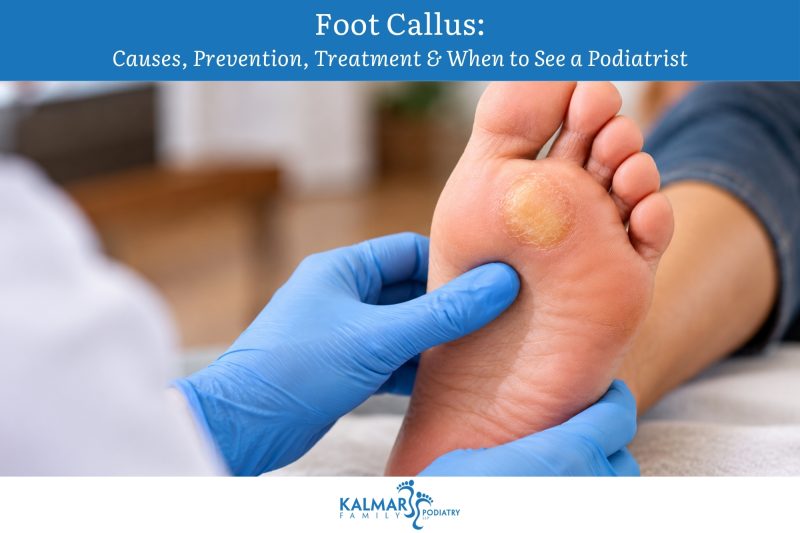 foot-callus-causes-prevention-treatment