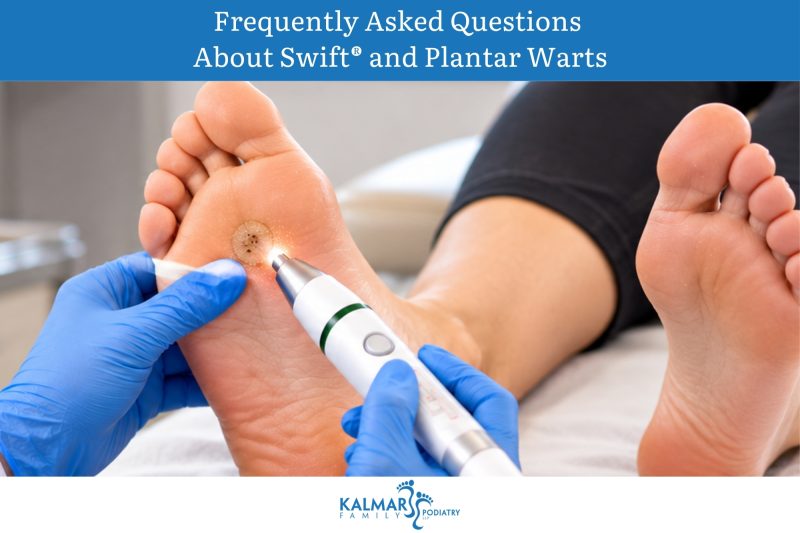 Frequently Asked Questions About Swift® and Plantar Warts