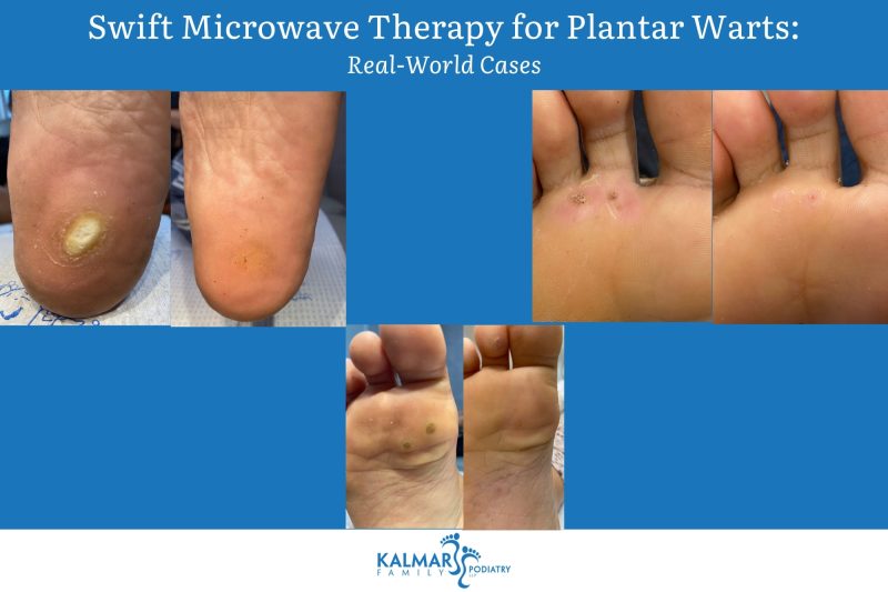 Swift Microwave Therapy for Plantar Warts Real-World Cases