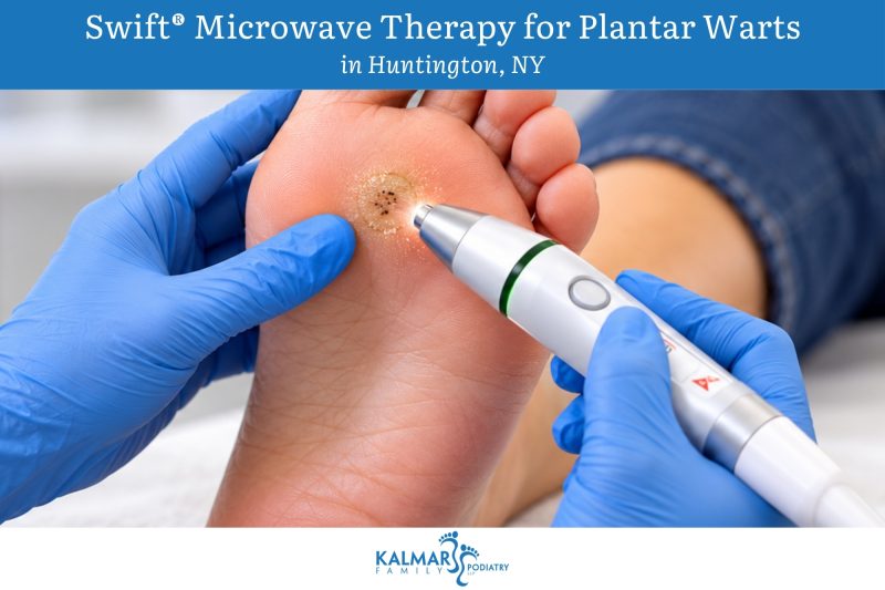 Swift® Microwave Therapy for Plantar Warts in Huntington, NY