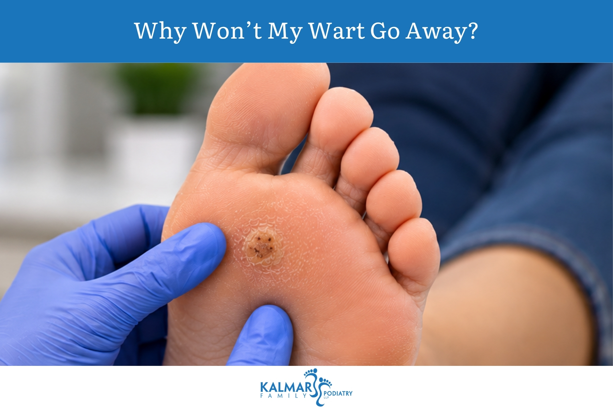 Why Won’t My Wart Go Away